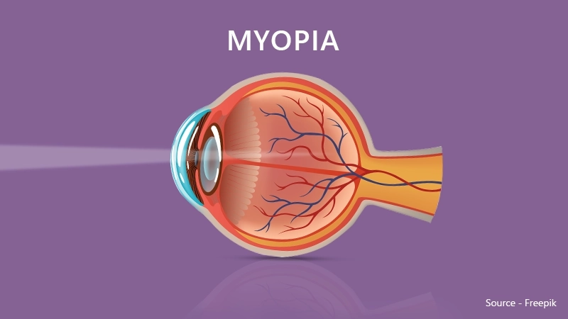 Understanding myopia and prescription lenses: A diagram of a nearsighted eye where light enters and focuses incorrectly.
