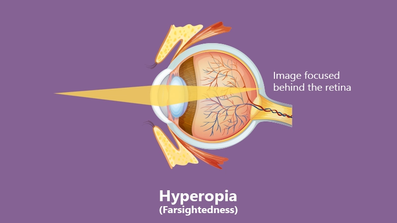 Understanding Hyperopia or farsightedness: A medical graphic illustrating how light enters the eye and focuses incorrectly behind the retina.