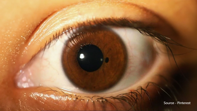 Extreme close-up of a human brown iris with polycoria, showing one large central pupil and a second, much smaller, distinct pupil next to it.