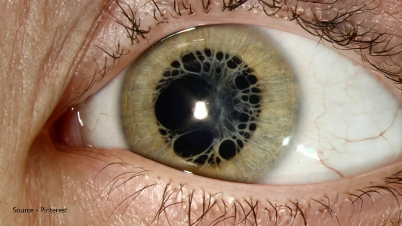 Extreme close-up of a human eye with a severe form of polycoria, showing multiple irregular and misshapen pupils scattered across the light green iris.