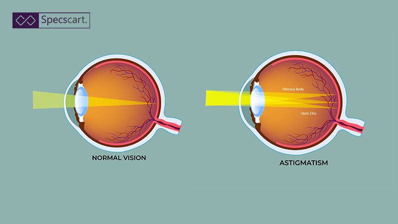 A clear side-by-side diagram illustrating light entering the eye: focusing sharply on the retina for Normal Vision, versus scattering across the retina for Astigmatism.