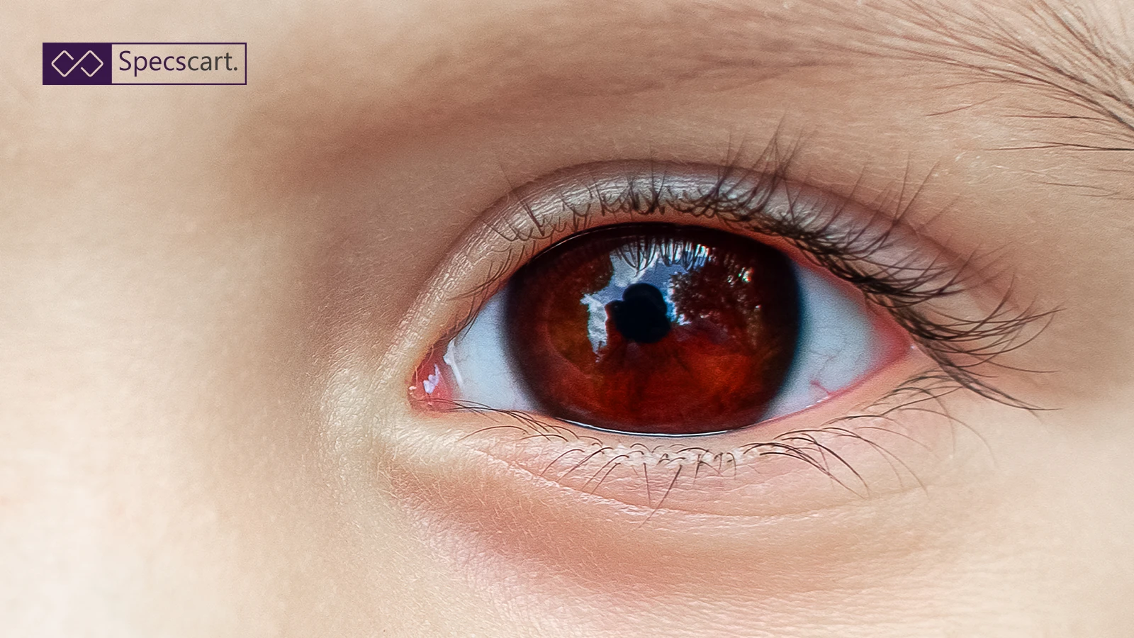 What is Hyphema: Causes, Symptoms, Diagnosis and Treatment? What is Hyphema: Causes, Symptoms, Diagnosis and Treatment?