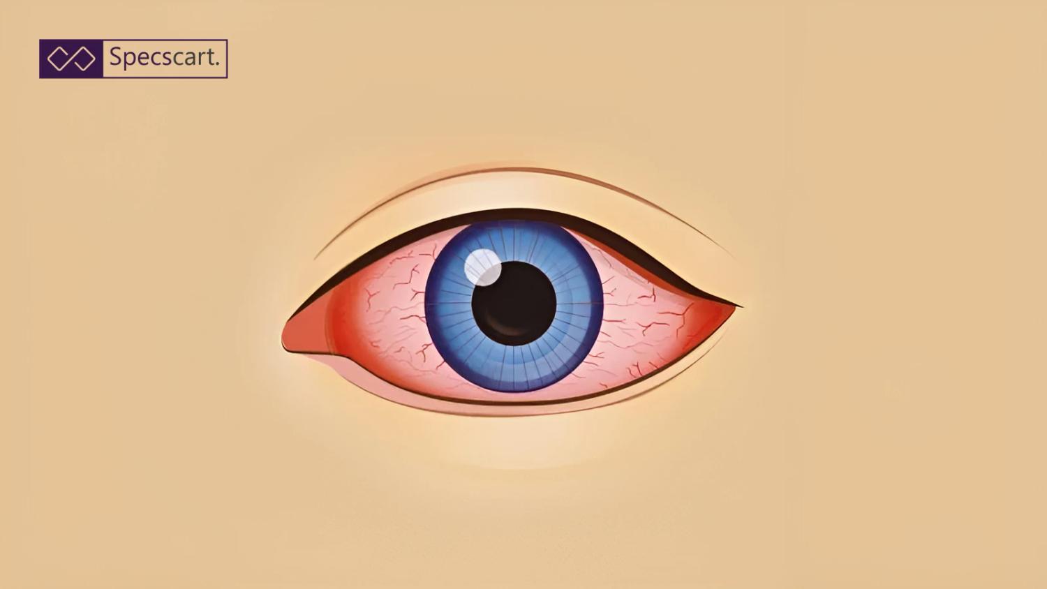 Illustration of a blue eye with red, bloodshot whites and visible veins against a neutral tan background.