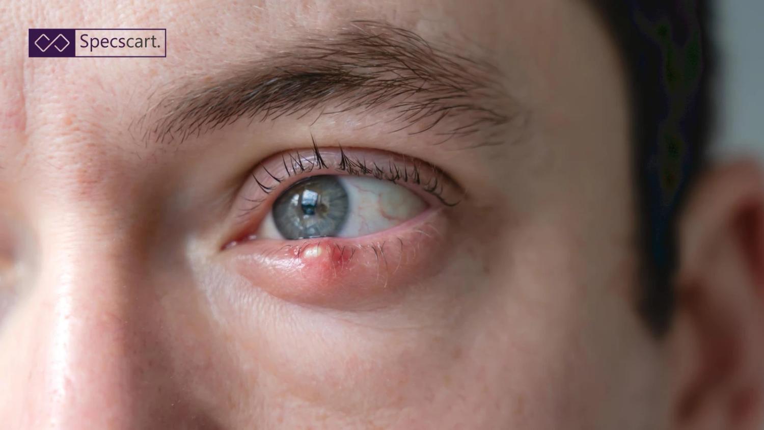 Close-up of a human eye with a red, swollen stye on the lower eyelid, showing a painful-looking bump near the lash line against a neutral skin tone.