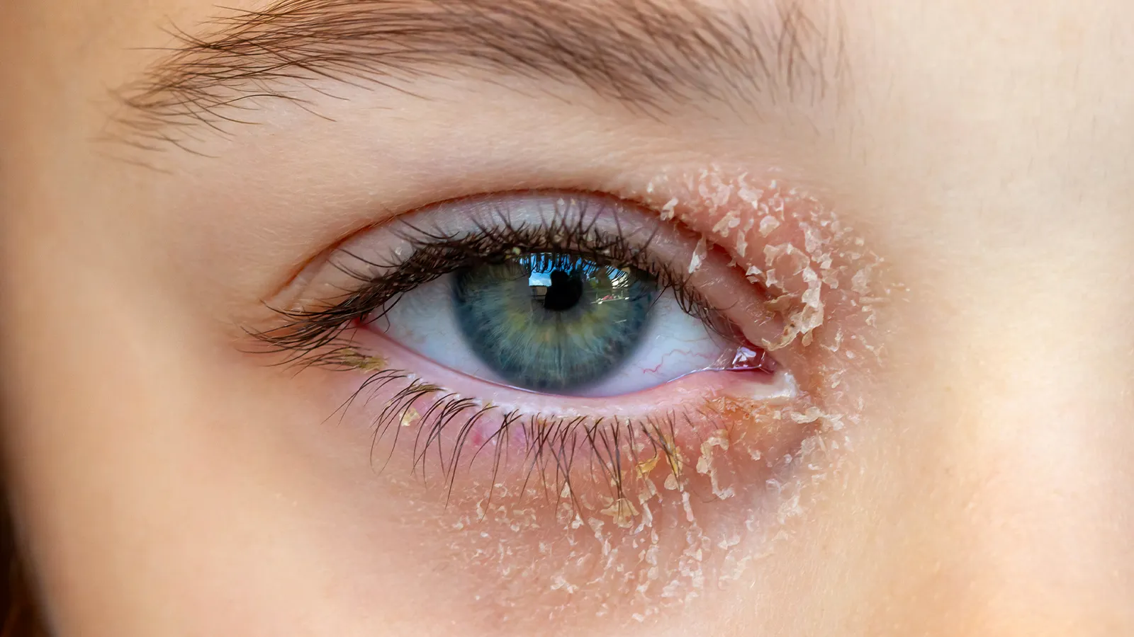 What is Eye Discharge