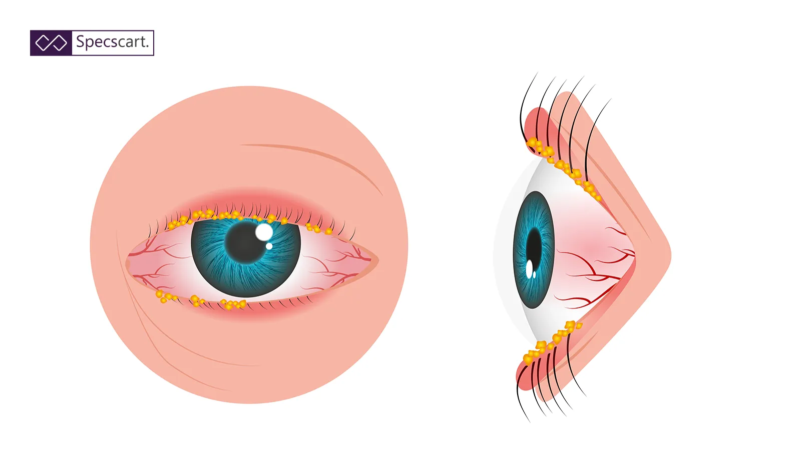 What is Eye Discharge? Why Does it Develop Around the Eye? undefined