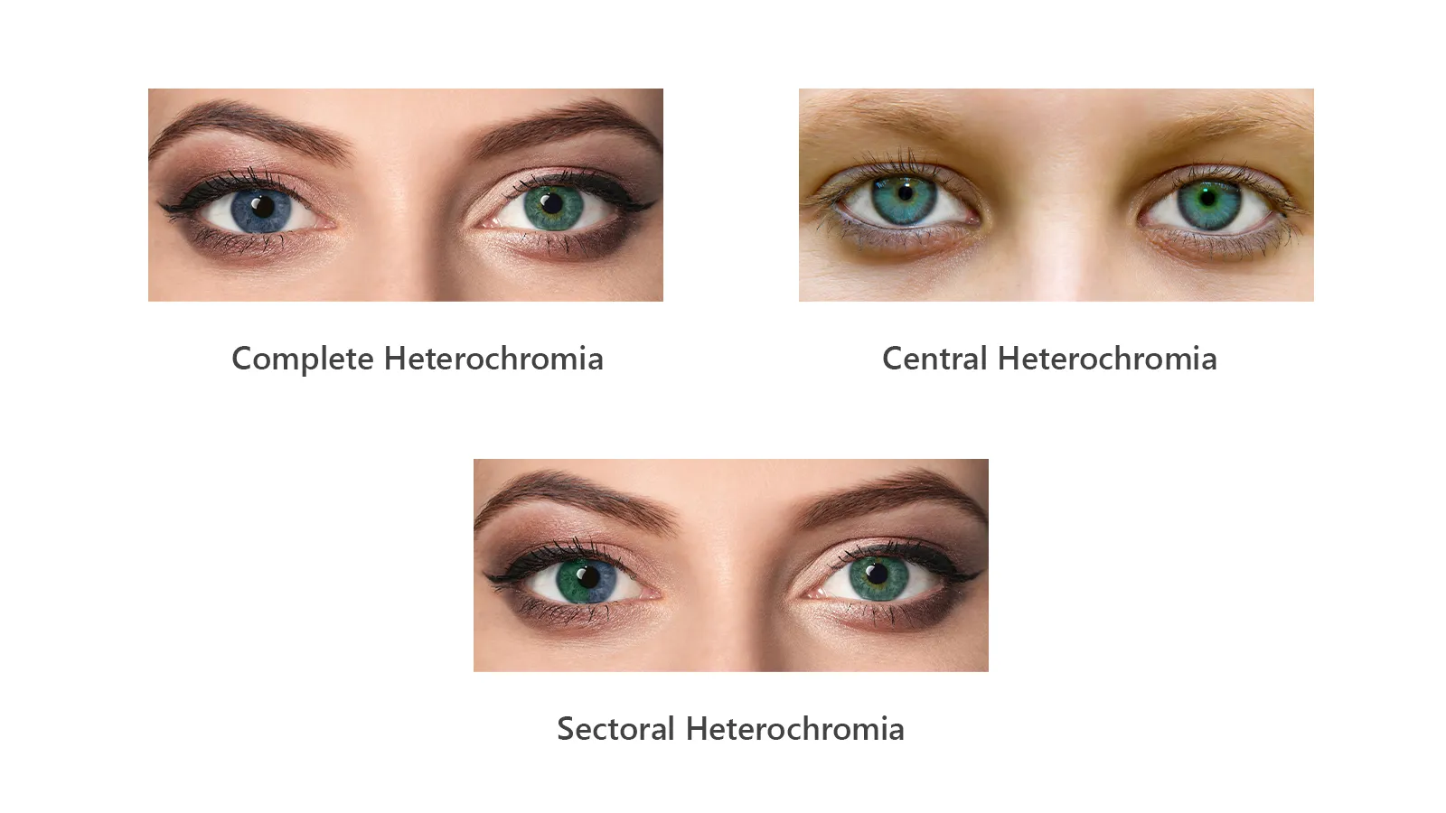 Infographic showing three types of heterochromia: 'Complete Heterochromia' with two different colored eyes, 'Central Heterochromia' with a different colour around the pupil, and 'Sectoral Heterochromia' with two colours in the same iris.