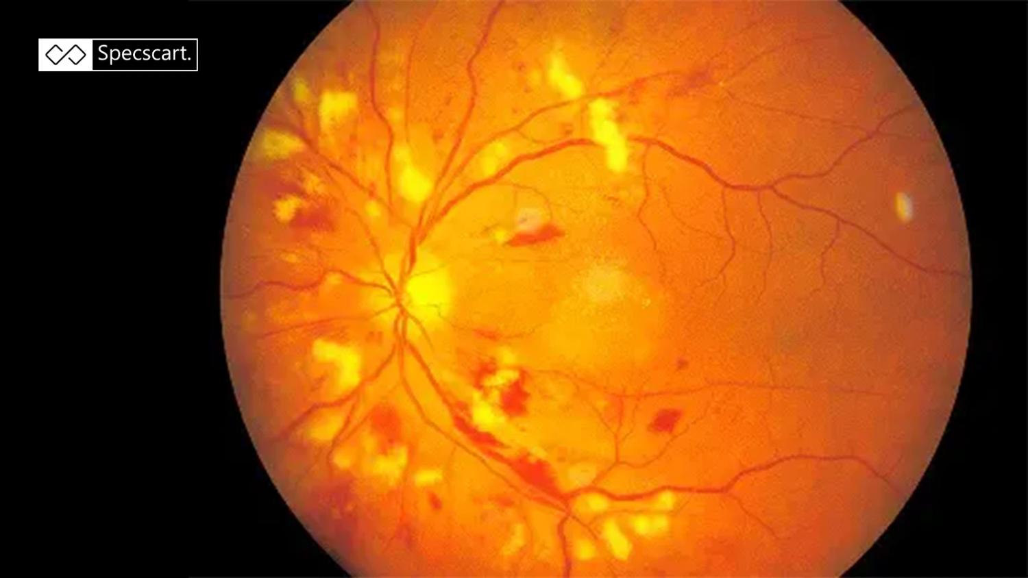 The Silent Threat of Hypertensive Retinopathy