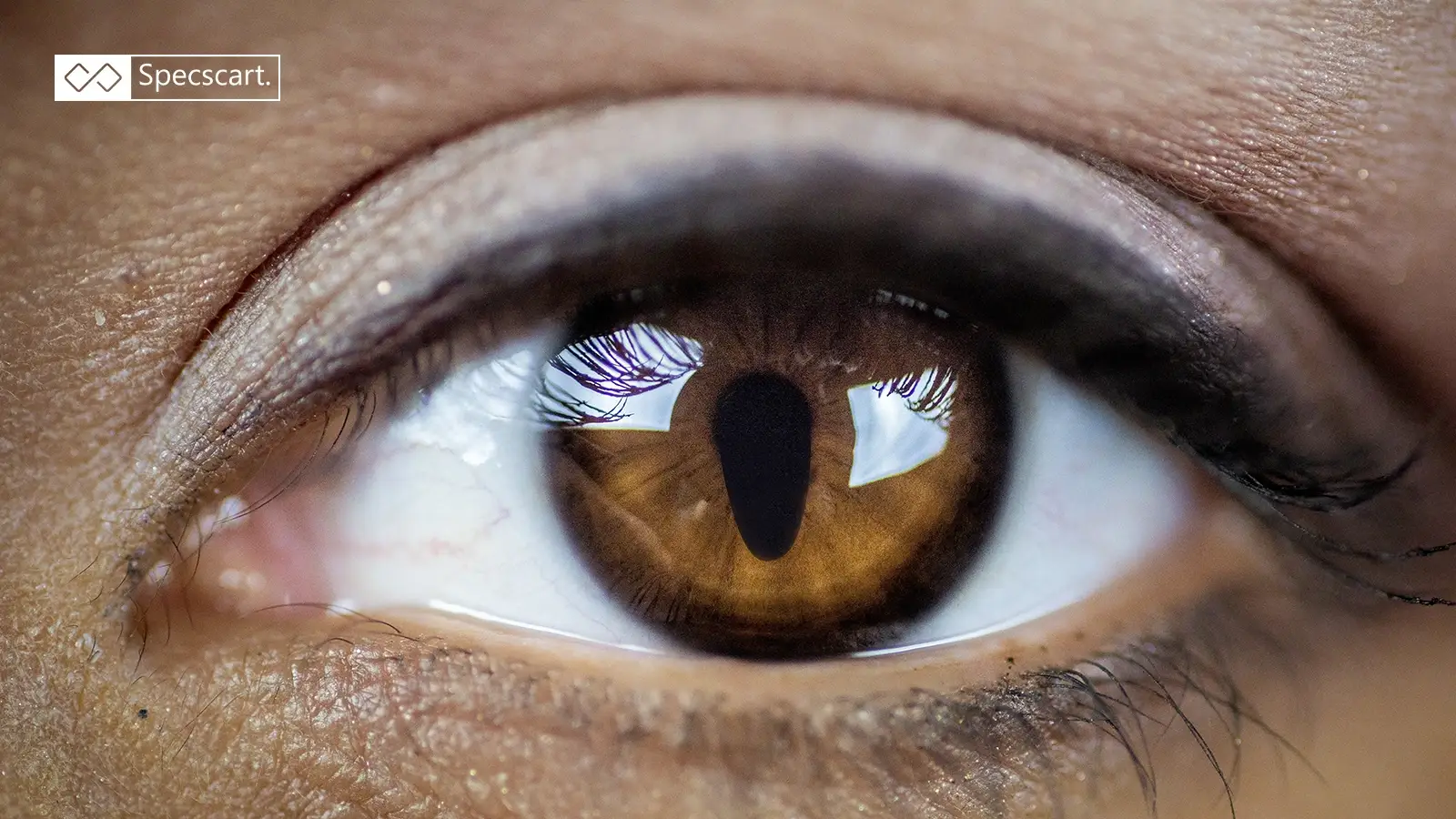 Detailed image of an eye affected by coloboma, illustrating the structural gap in the iris and elongated pupil.