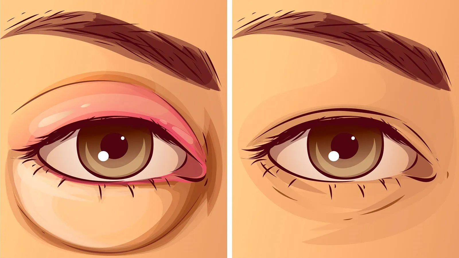 Illustration comparing a red, swollen eye on the left and a healthy, normal eye on the right.